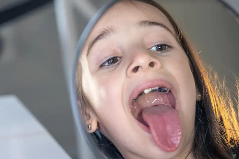 Cáries em Dentes de Leite: O Guia Completo para Prevenir e Proteger o Sorriso do Seu Filho